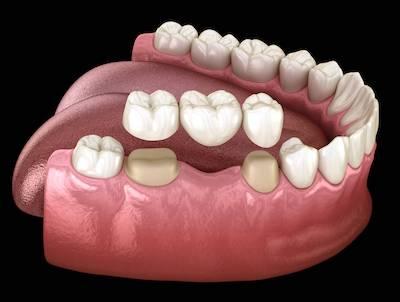 dental bridge going into missing teeth | dental bridges parramatta